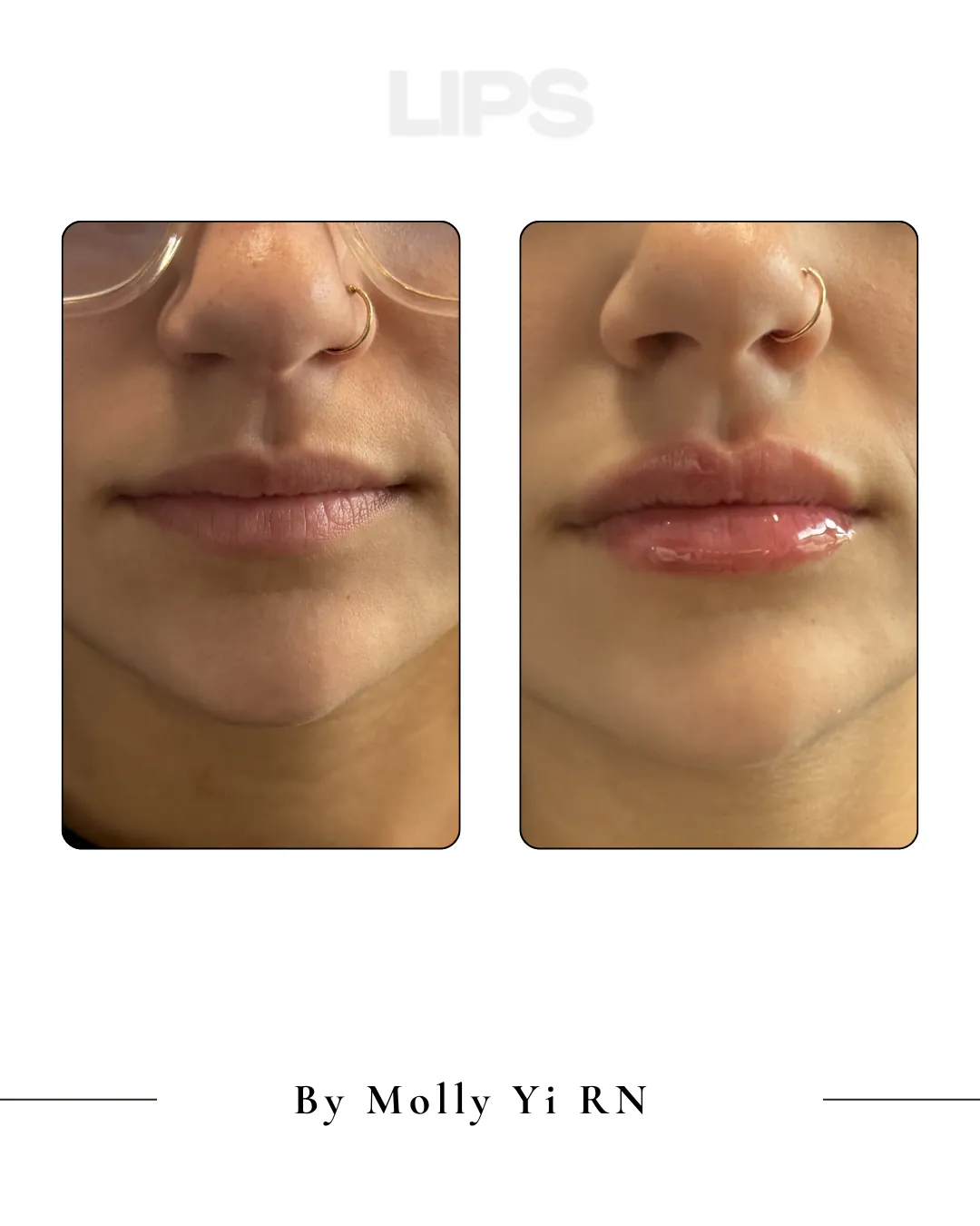 Lip filler before and after, by Molly Yi, RN