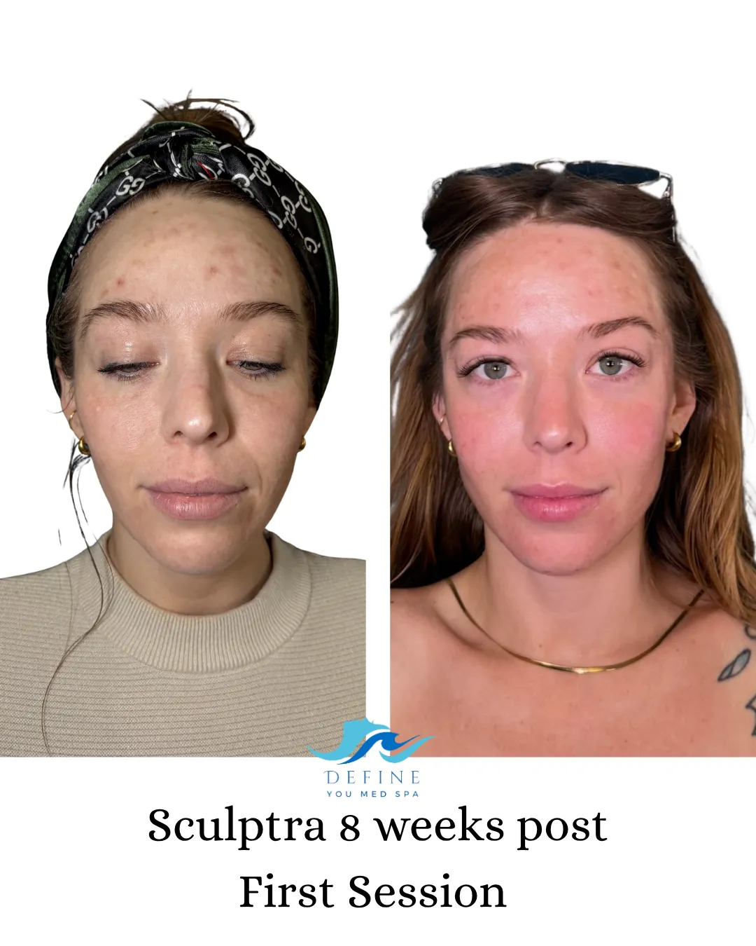 Sculptra before and 8 weeks after the first session