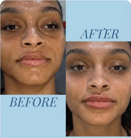 Before and after aesthetic treatment at Define You Med Spa